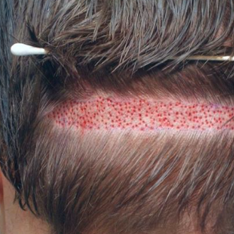hairtransplantinlahore