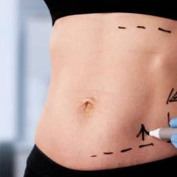 liposuction